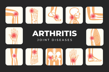 Set of different types of Arthritis infographic poster, Joint disease pain in human body, Types of joint pain medical poster, Inflammatory Rheumatoid Arthritis, healthy lifestyle concept. - obrazy, fototapety, plakaty