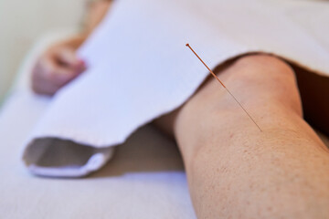 Acupuncture needle on chakra point on the low knee of a patient to heal body with Chinese...