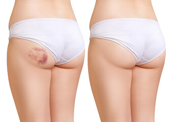 Hematoma on a woman's hips before and after treatment.