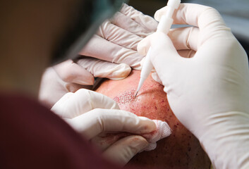 Hair transplant surgery with dhı pencil in close-up. The hands of the doctor performing the hair transplant and the patient's scalp.