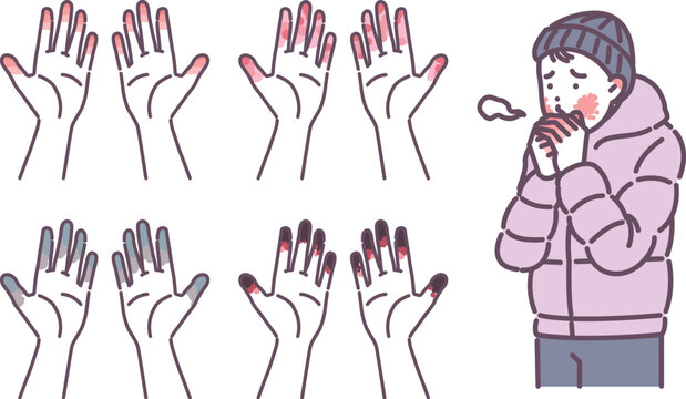 illustration of a person with frostbite on his hand