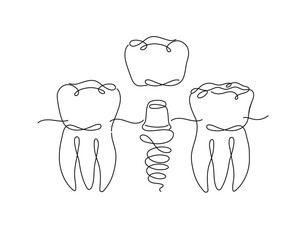 Teeth implant illustration drawing in flat line style on white background