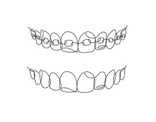 Jaws with and without braces installed drawing in flat line style on white background