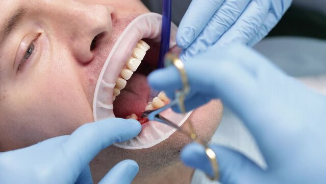 Suturing around healing abutment, often referred to as a healing cap or gingival former. Dental implant procedure