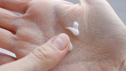Using hand cream for dry skin close-up moisturizing palms and treating dermatitis with cream...
