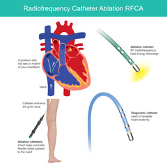 Radio frequency Catheter Ablation. Medical procedure is used to help control the heart rhythm problems such as atrial fibrillation..