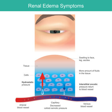 Renal Edema Symptoms. Severe swelling the medical called edema, occur particularly around eyes..