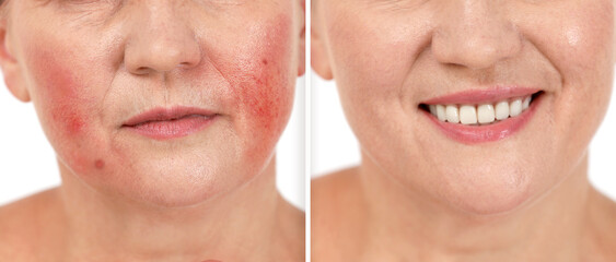 Before and after rosacea treatment. Photos of woman on white background, closeup. Collage showing...