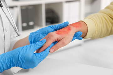 Obraz premium Doctor examining patient's burned hand indoors, closeup