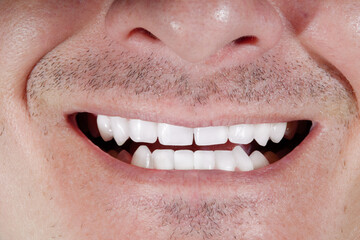 Close Up of a Man's Smile After Teeth Whitening and Ceramic Veeneers Restoration For Perfect...