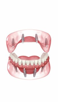 Prostheses supported by 8 implants. Dental 3D animation