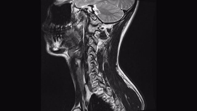 Magnetic Resonance images of cervical spine sagittal. C5 ,C6, C7 injured disc disease, MRI