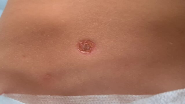 Shingles disease. Symptom of herpes virus in human body and skin rash and blisters on body