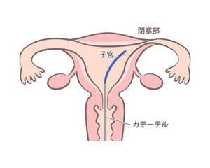  ＦＴ　卵管鏡下卵管形成術　の子宮のイラスト