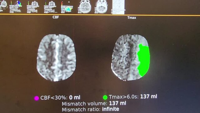 Brain Perfusion Imaging - Cerebral Angiography w CVA in Color