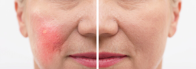 Before and after rosacea treatment. Photos of woman on white background, closeup. Collage showing...