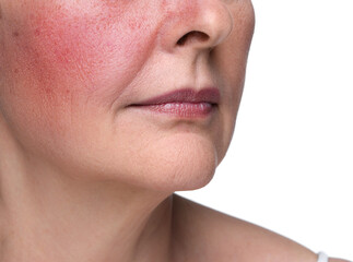 Woman with rosacea on white background, closeup. Problem skin treatment