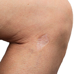 Fototapeta premium scar on the skin of the leg as a background.