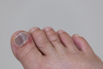 old female healthy foot hurt toenail need foe medical care. finger cracked hematoma purple color on...