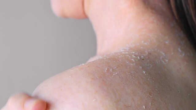 Peeling skin on shoulder due to dehydration close-up rear view effect of dehydration on skin dermatology and cosmetology, concept of dehydration and peeling of skin problems with skin