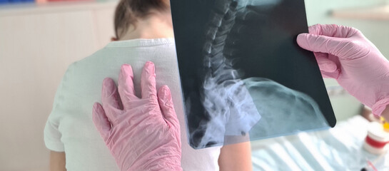 Pediatrician doctor examines x-ray of child spinal deformity - obrazy, fototapety, plakaty