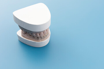 Dental Mold, Gypsum Model Plaster Cast For Teeth Molar In Laboratory On Blue Background. Human Jaw. Preparing Invisible Braces, Aligner Or Night Guard For Bruxism, Dentures. Copy Space For Text.
