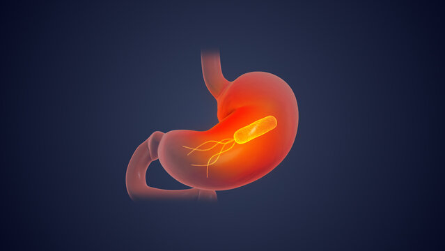 Helicobacter pylori in human stomach	