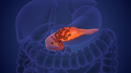 Cancer cell proliferation and injury to the pancreas	
