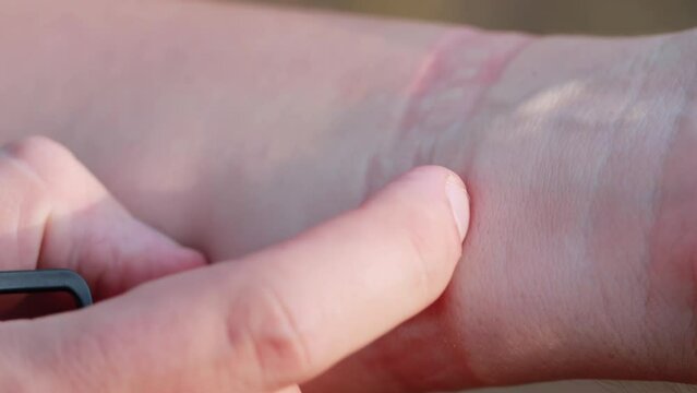 A fitness bracelet with a silicone strap taken from a person s hand. Redness, irritation and itching on the hand from the watch strap. Allergic contact dermatitis, macro. Slow motion