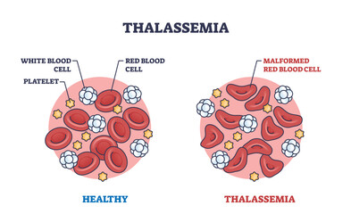 Thalassemia blood disorder caused by lack of hemoglobin outline diagram. Labeled educational scheme with healthy red blood cells vs malformed vector illustration. Microbiological disorder explanation
