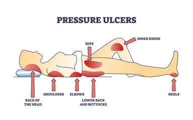 Pressure ulcers or bedsores skin tissue injuries locations outline diagram. Labeled educational scheme with stationary laying patient caused dermatological conditions on body vector illustration. - obrazy, fototapety, plakaty