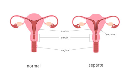 Septate and normal human uterus structure. Uterine septum as a congenital uterine malformation. Anatomy chart. Vector illustration