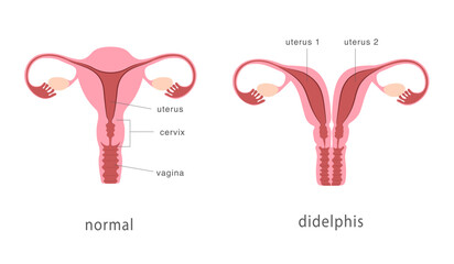 Didelphis and normal human uterus structure. Uterine deep septum as a congenital uterine malformation. Anatomy chart. Vector illustration - obrazy, fototapety, plakaty