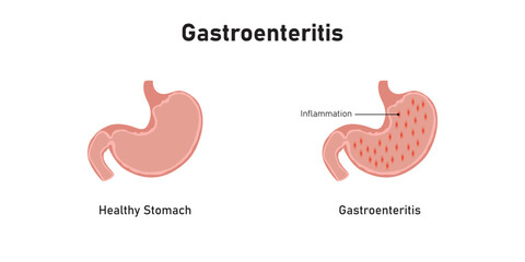 Gastroenteritis Disease Scientific Design. Vector Illustration.