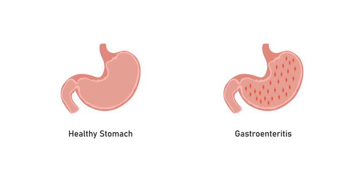 Gastroenteritis Disease Scientific Design. Vector Illustration.