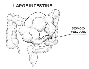 Bowel obstruction. Sigmoid volvulus. Line art drawing. Healthcare illustration. Vector illustration.  - obrazy, fototapety, plakaty