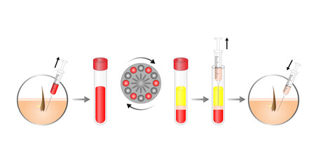Platelet-rich plasma (prp). Autologous conditioned plasma, is a concentrate of PRP extracted from whole blood. After centrifugation, extract PRP and inject skin or hair. Vector Illustration.
