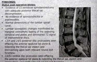 MRI lumbosacral spine shows L5 Vertebrae Spinal laminectomy evidence, posterior thecal sac...