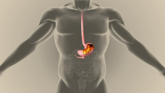 Gerd acidity stomach reflux heartburn ache