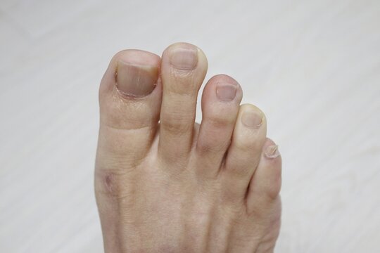 cold hands and feet
