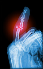 Real X-ray scan - broken finger side view. Pinky finger phalanx displace fracture. Radiology...