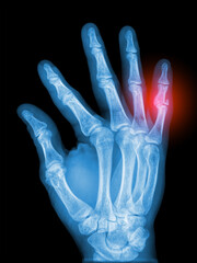 Real hand X-ray scan - broken pinky finger. Phalanx displace fracture. Radiology diagnosis.