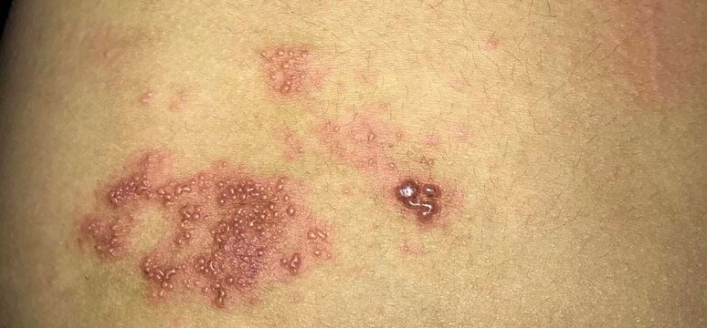 Herpes simplex infection at back of Asian patient. Small and painful vesicles.