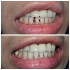 Before and after closure of huge gap between lower teeth, diastema.
