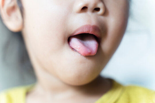 Hand-foot-and-mouth disease or HFMD, is caused by a virus. Close up of a infected wollen tongue with blisters.