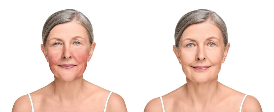 Before and after rosacea treatment. Photos of woman on white background. Collage showing affected and healthy skin