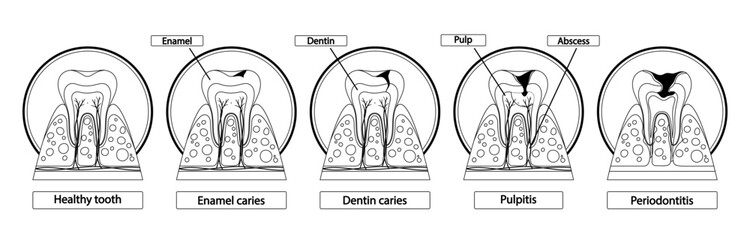 Stages Of Caries Infographic. Healthy Tooth, Enamel Caries, Dentin Caries, Pulpitis and Periodontitis Cross Section View - obrazy, fototapety, plakaty