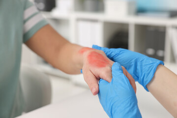 Doctor examining patient's burned hand indoors, closeup