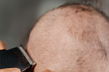 shaving woman because of a cancerous tumor. removal of hair on the head with an electric razor...