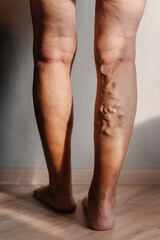 Varicose veins in a woman. swelling of veins in the legs of an elderly person. clogged veins with plugs on a person's legs - obrazy, fototapety, plakaty
